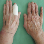 Артрит на ръцете: лечение, симптоми и снимки на ранен етап