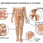 Артрит на краката: симптоми, лечение и снимка на краката