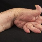 Артрит на ръцете: симптоми, лечение и снимки на ставите