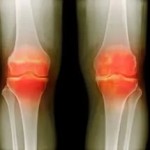 Артрит: предотвратяване на усложненията и последиците от ревматоиден артрит