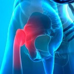 Артроза-артрит на ставите (коляно, рамо): лечение на артроартрит