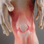 Артроза-артрит на ставите (коляно, рамо): лечение на артроартрит