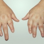 Артроза на пръстите: как и какво да лекува, преглед на народни средства