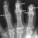 Артроза на ръцете: лечение, симптоми и снимки на ставите