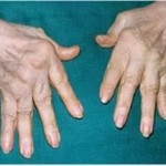 Артроза на ръцете: лечение, симптоми и снимки на ставите
