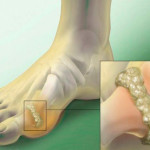 Артроза на метатарсофалагеална става: лечение на краката
