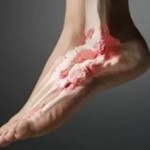 Артроза на метатарсофалагеална става: лечение на краката