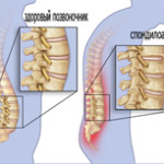 Остеоартрит на гръбначния стълб: симптоми и лечение на междупрешленни стави