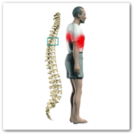 Остеоартрит на гръбначния стълб: симптоми и лечение на междупрешленни стави