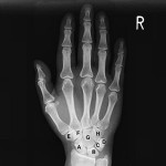 Остеоартрит на китката: симптоми, лечение и снимка на китката на ръката
