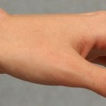 Ставна херния по китката: лечение на ставата на ръката