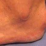 Бурсит на глезена: лечение, симптоми, снимка на крака