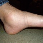 Бурсит на глезена: лечение, симптоми, снимка на крака