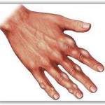 Бурсит на пръста: лечение и снимка на ставата