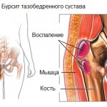 Бурсит на тазобедрената става: симптоми и лечение на гръбначния стълб