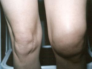 Причини, симптоми и лечение на остеоартрит на коляното