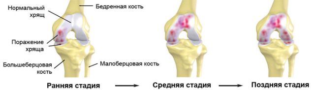 Причини, симптоми и лечение на остеоартрит на коляното