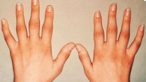 Причини, симптоми и лечение на остеоартрит на пръстите