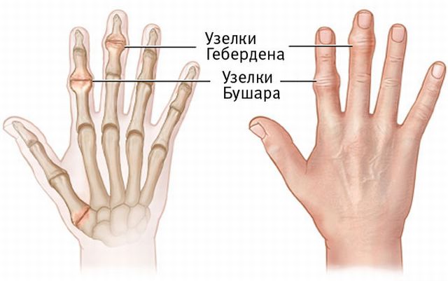 Причини, симптоми и лечение на остеоартрит на пръстите