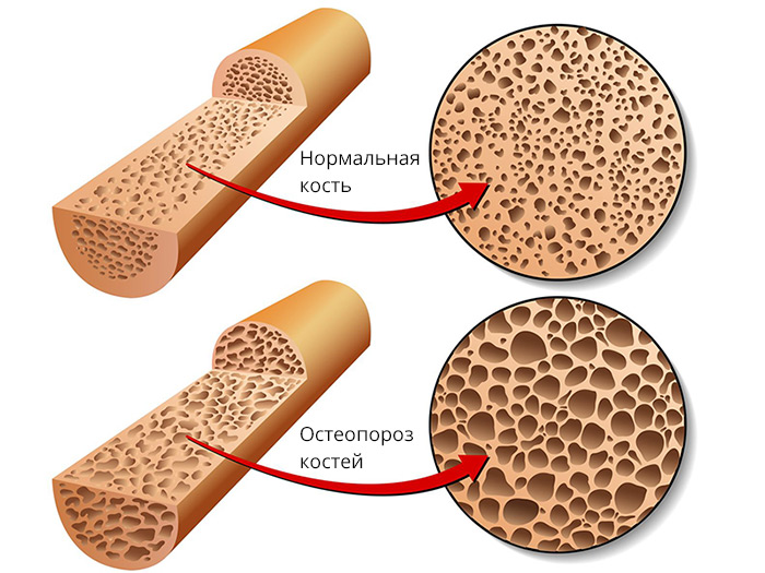 Причини, признаци и лечение на остеопороза