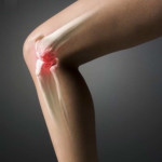 Хондроматоза на колянните и тазобедрените стави: симптоми и лечение