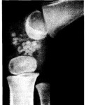 Хондроматоза на колянните и тазобедрените стави: симптоми и лечение