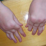 Хроничен ювенилен артрит при деца: лечение и симптоми