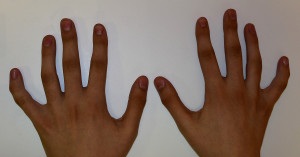 Clinodactyly - вродена аномалия на развитието на пръстите на пръстите