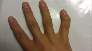 Clinodactyly - вродена аномалия на развитието на пръстите на пръстите