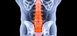 Компресионна фрактура на лумбалния гръбначен стълб: лечение и последици