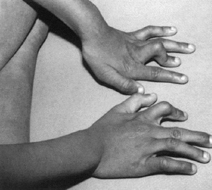 Вродена патология на пръстите на кампдодактилната четка