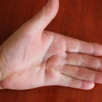 Договор за пръсти: обработка на четката от контрактурата на Dupuytren