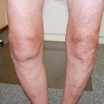 Контрактура на колянната става: какво е това, лечение на коляното