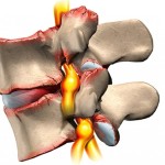 Дефект на Schmorl прешлени: какво е това, лечение на гръбначния стълб