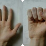 Деформация на ставите: обработка на кривината на пръстите