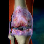 Деформиране на артрит на коляното: Симптоми и лечение