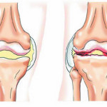 Деформиране на артрит на коляното: Симптоми и лечение