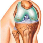 Деформиране на артрозата на колянната става: лечение на дефарктоза 1 и 2 градуса