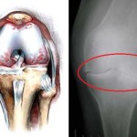 Деформиране на артрозата на колянната става: лечение на дефарктоза 1 и 2 градуса