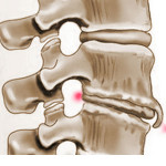 Деформиране на спондилартроза: лечение на гръбначния стълб