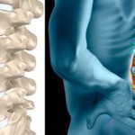 Деформиране на спондилартроза: лечение на гръбначния стълб