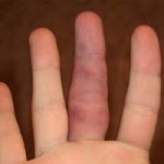 Болести на ставите на пръстите: снимки и лечение на заболявания