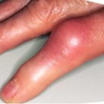Болести на ставите на пръстите: снимки и лечение на заболявания