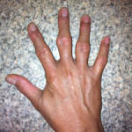 Болести на ставите на ръцете: симптоми и лечение на болка