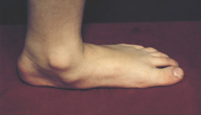 Плоски крака: спиране на валгус при детето