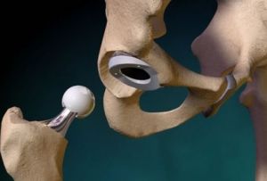 Фрактура на ацетабулума: терапията и последиците от травмата