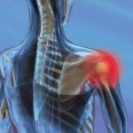 Синдром на замразеното рамо: лечение и симптоми