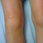 Хемартроза на коляното: какво е това, лечение на коляното
