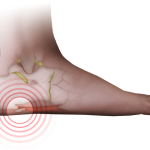 Крака на петата: лазерно лечение на петата, ревюта за процедурата