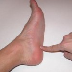 Как се стича токчето: лечение на крака, снимка на петата